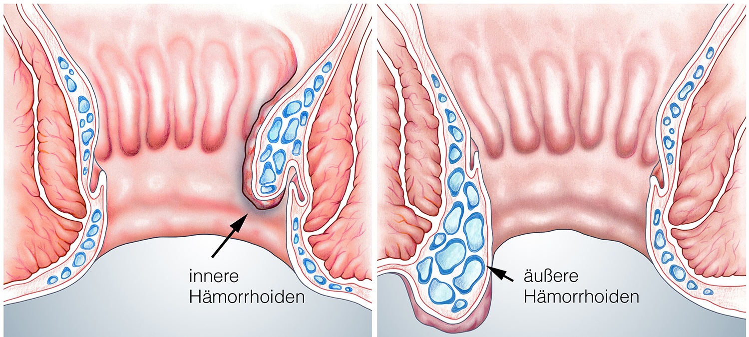 Hämorrhoiden außen, Schaubild Hämorrhoiden